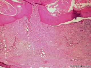 毛鞘瘤？图8