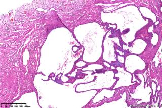 请老师们帮看看这个输卵管是积水性改变还是有囊肿？图2