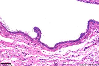 请老师们帮看看这个输卵管是积水性改变还是有囊肿？图14