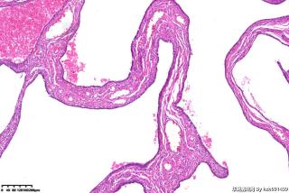 请老师们帮看看这个输卵管是积水性改变还是有囊肿？图10