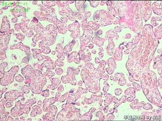早产50天胎盘，有问题吗？胎盘标本重点看什么呢？请教！图4