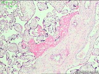 早产50天胎盘，有问题吗？胎盘标本重点看什么呢？请教！图11