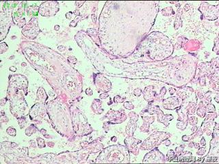 早产50天胎盘，有问题吗？胎盘标本重点看什么呢？请教！图9