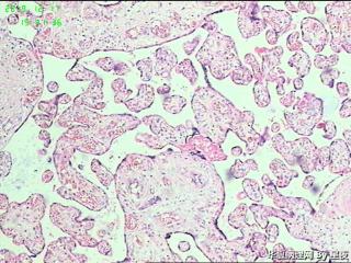 早产50天胎盘，有问题吗？胎盘标本重点看什么呢？请教！图5