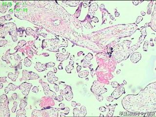 早产50天胎盘，有问题吗？胎盘标本重点看什么呢？请教！图10