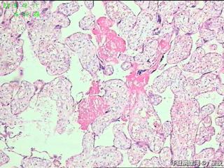 早产50天胎盘，有问题吗？胎盘标本重点看什么呢？请教！图15