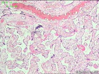 早产50天胎盘，有问题吗？胎盘标本重点看什么呢？请教！图13