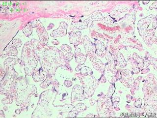 早产50天胎盘，有问题吗？胎盘标本重点看什么呢？请教！图14