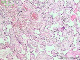 早产50天胎盘，有问题吗？胎盘标本重点看什么呢？请教！图1
