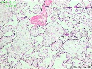 早产50天胎盘，有问题吗？胎盘标本重点看什么呢？请教！图12