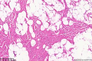 背部包块，纤维脂肪瘤？图13