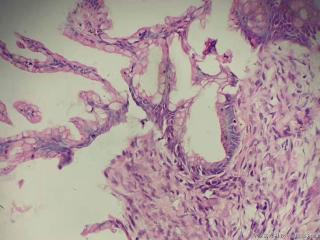 交界性粘液性肿瘤？图8