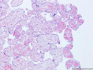 胎盘病理--红细胞呈泡状，并且有有核红细胞该如何报呢图4