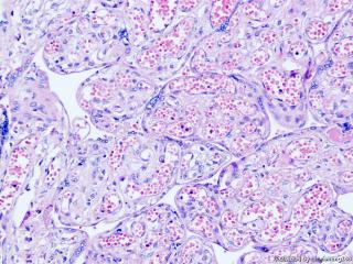 胎盘病理--红细胞呈泡状，并且有有核红细胞该如何报呢图12