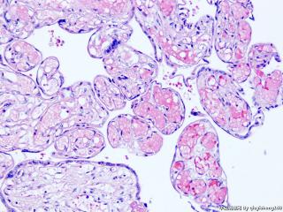 胎盘病理--红细胞呈泡状，并且有有核红细胞该如何报呢图5