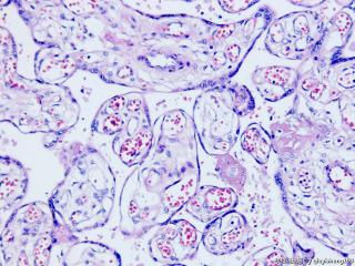 胎盘病理--红细胞呈泡状，并且有有核红细胞该如何报呢图7