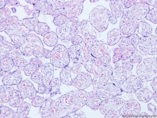 胎盘病理--红细胞呈泡状，并且有有核红细胞该如何报呢图11