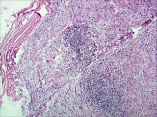 炎性假瘤？炎性肌纤维母细胞瘤？纤维组织细胞瘤？图5