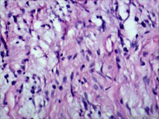 炎性假瘤？炎性肌纤维母细胞瘤？纤维组织细胞瘤？图16