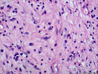 炎性假瘤？炎性肌纤维母细胞瘤？纤维组织细胞瘤？图22