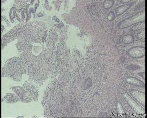 求教，结肠不规则增生性肿物，肠镜活检图4