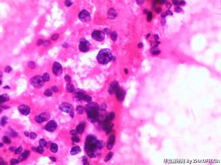 左侧甲状腺包块穿刺细胞学图12