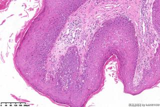 寻常疣？图12