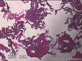 宫颈赘生物图16