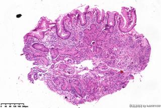 胃体粘膜息肉，增生性息肉？图9