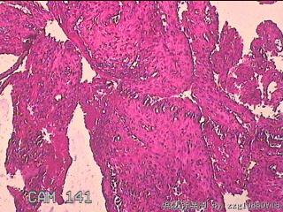宫颈赘生物图7