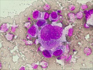 少许可疑腺癌细胞？图2