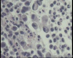 急！求老师看看胃镜活检这些细胞是泡沫细胞吗？还是印戒细胞？图8