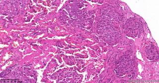 食管占位，低分化鳞状细胞癌？图18