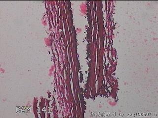 右输卵管系膜囊肿图22