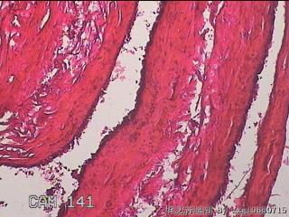 右输卵管系膜囊肿图26