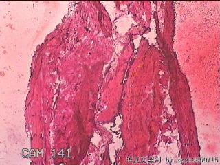 右输卵管系膜囊肿图11