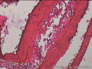 右输卵管系膜囊肿图25