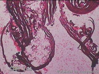 右输卵管系膜囊肿图10