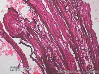 右输卵管系膜囊肿图3