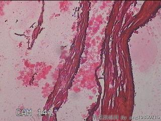 右输卵管系膜囊肿图29