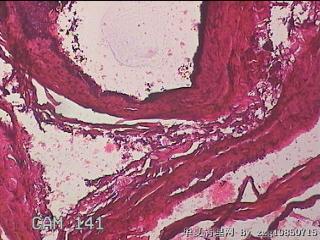 右输卵管系膜囊肿图16