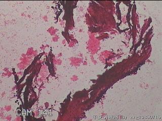 右输卵管系膜囊肿图21