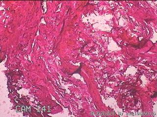 右输卵管系膜囊肿图12