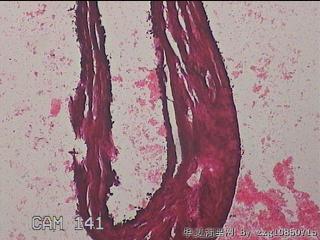右输卵管系膜囊肿图19