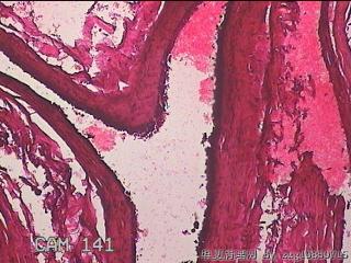 右输卵管系膜囊肿图17