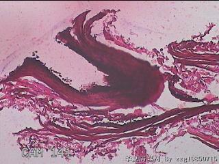 右输卵管系膜囊肿图1