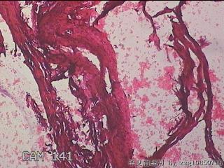 右输卵管系膜囊肿图15