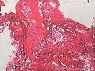 右输卵管系膜囊肿图24