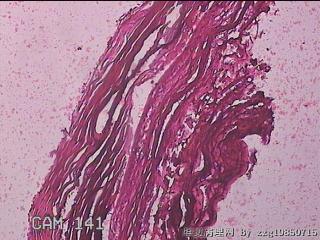 右输卵管系膜囊肿图8