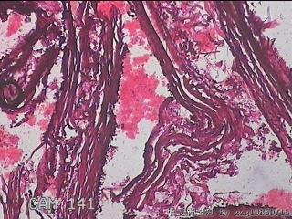 右输卵管系膜囊肿图5